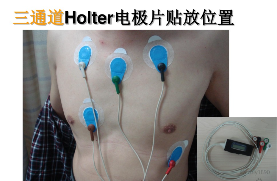 怎么装动态心电图手把手教你如何在龙台医院做动态心电图_https://www.jmylbn.com_新闻资讯_第11张