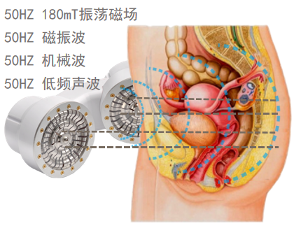 盆腔炎治疗仪是什么盆腔炎、输卵管阻塞克星来了！斗门妇幼引进永磁旋振治疗仪_https://www.jmylbn.com_新闻资讯_第4张