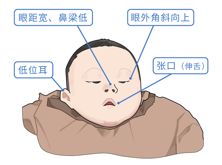 世界唐氏综合征日|预防唐氏,关爱唐氏儿
