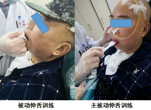 老年人吃饭难题|出现吞咽困难,别慌,这几个在家就能做的训练,可以帮