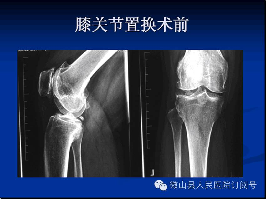 抗栓泵怎么用【科室简介】微山县人民医院 骨科 济宁市重点专科_https://www.jmylbn.com_新闻资讯_第16张