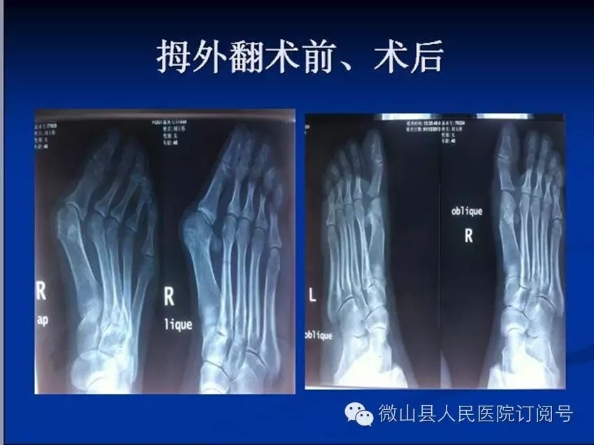 抗栓泵怎么用【科室简介】微山县人民医院 骨科 济宁市重点专科_https://www.jmylbn.com_新闻资讯_第19张