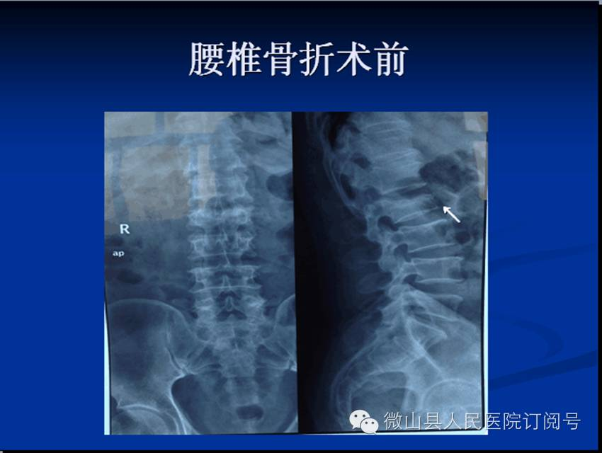 抗栓泵怎么用【科室简介】微山县人民医院 骨科 济宁市重点专科_https://www.jmylbn.com_新闻资讯_第13张