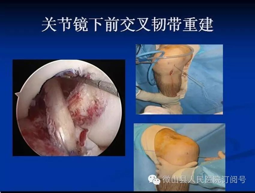 抗栓泵怎么用【科室简介】微山县人民医院 骨科 济宁市重点专科_https://www.jmylbn.com_新闻资讯_第18张