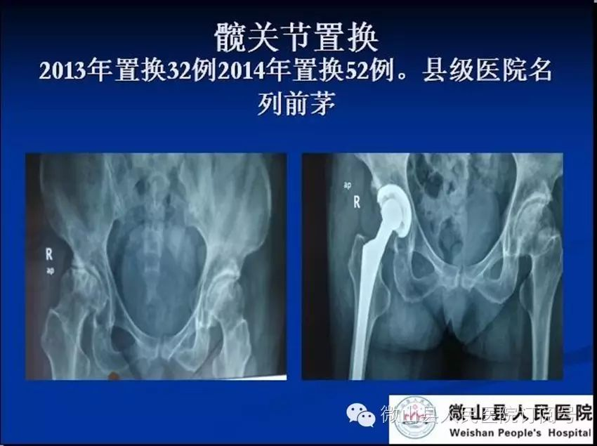 抗栓泵怎么用【科室简介】微山县人民医院 骨科 济宁市重点专科_https://www.jmylbn.com_新闻资讯_第15张