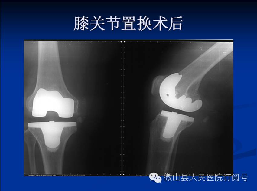 抗栓泵怎么用【科室简介】微山县人民医院 骨科 济宁市重点专科_https://www.jmylbn.com_新闻资讯_第17张