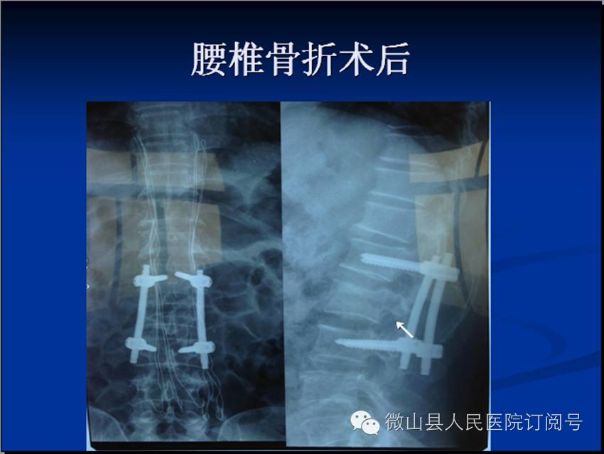抗栓泵怎么用【科室简介】微山县人民医院 骨科 济宁市重点专科_https://www.jmylbn.com_新闻资讯_第14张