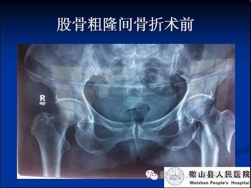 抗栓泵怎么用【科室简介】微山县人民医院 骨科 济宁市重点专科_https://www.jmylbn.com_新闻资讯_第11张