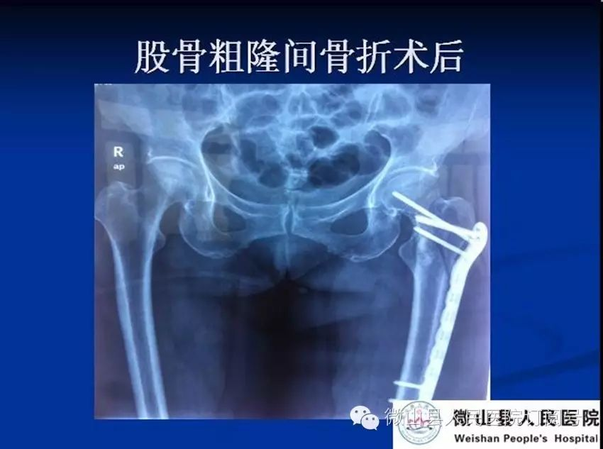 抗栓泵怎么用【科室简介】微山县人民医院 骨科 济宁市重点专科_https://www.jmylbn.com_新闻资讯_第12张