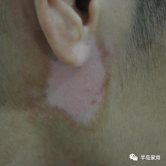 光疗时为什么黑眼罩半岛家用308准分子光疗仪最全操作指南_https://www.jmylbn.com_新闻资讯_第6张