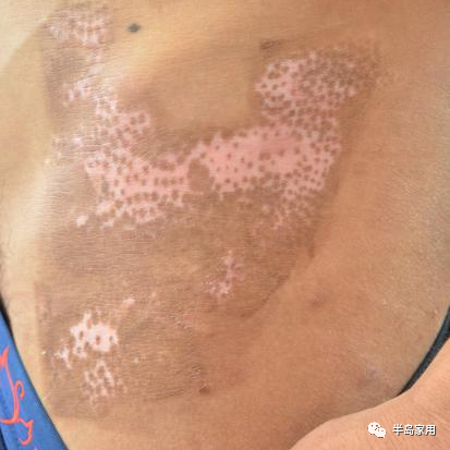 光疗时为什么黑眼罩半岛家用308准分子光疗仪最全操作指南_https://www.jmylbn.com_新闻资讯_第7张