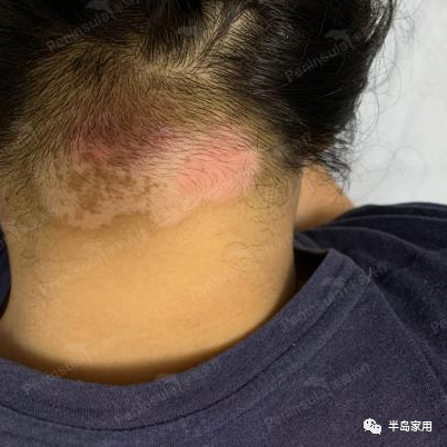 光疗时为什么黑眼罩半岛家用308准分子光疗仪最全操作指南_https://www.jmylbn.com_新闻资讯_第9张