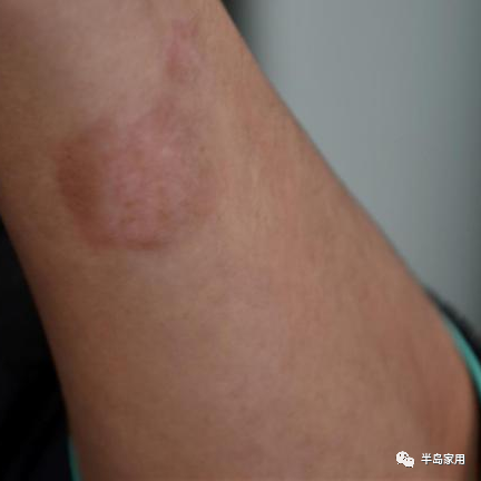 光疗时为什么黑眼罩半岛家用308准分子光疗仪最全操作指南_https://www.jmylbn.com_新闻资讯_第8张