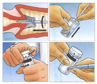 高质量宫颈细胞取样是如何做到的
