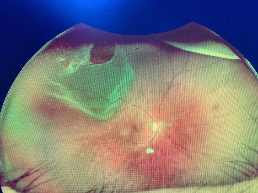 眼底激光机有什么牌子眼底检查“神器”！免扩瞳、0.4秒完成眼底照相，等你体验~_https://www.jmylbn.com_新闻资讯_第3张