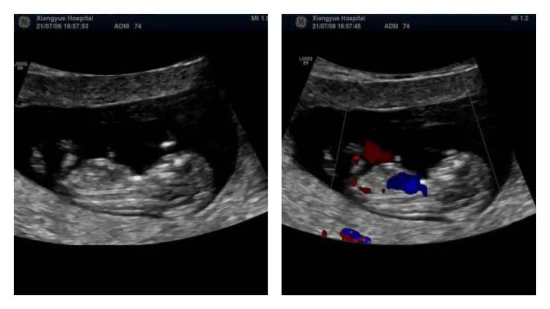 b超md是什么意思彩超不是彩色的？一文搞懂B超和彩超区别_https://www.jmylbn.com_新闻资讯_第7张