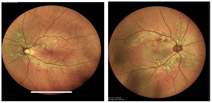 眼底照相有什么用眼底拍张照，眼病早知道！你的眼睛需要拍照吗？_https://www.jmylbn.com_新闻资讯_第9张