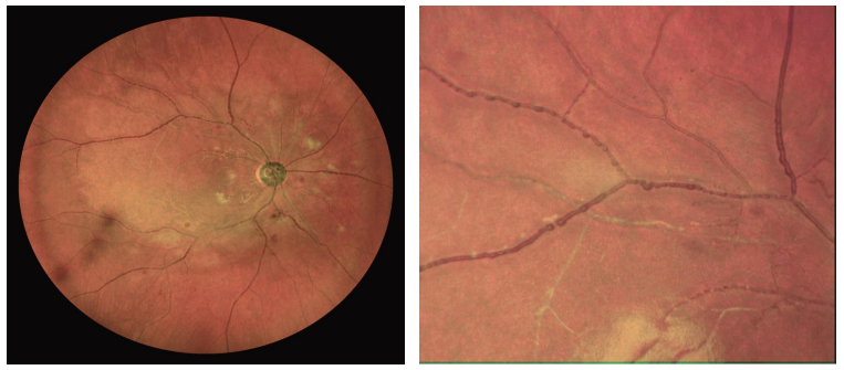 眼底照相有什么用眼底拍张照，眼病早知道！你的眼睛需要拍照吗？_https://www.jmylbn.com_新闻资讯_第11张