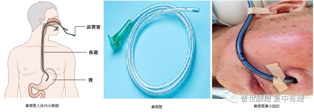 为什么要放负压球胰腺外科常见引流管的注意事项，您都知晓了吗？_https://www.jmylbn.com_新闻资讯_第1张