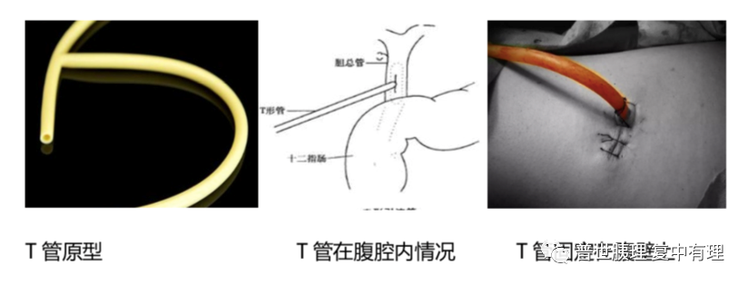 为什么要放负压球胰腺外科常见引流管的注意事项，您都知晓了吗？_https://www.jmylbn.com_新闻资讯_第2张