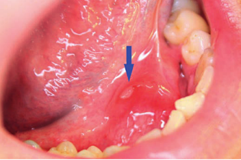 病变可能出现在任何黏膜表面,但多见于嘴唇,软腭和扁桃体