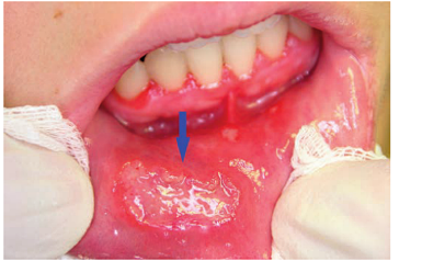 儿童复发性阿弗他溃疡_医学界-助力医生临床决策和职业成长