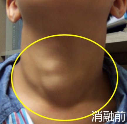 专家解读|确诊甲状腺结节？看懂超声报告单，合理治疗！