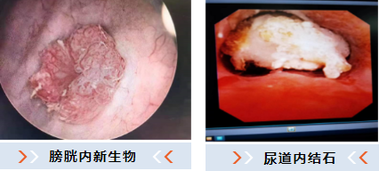 b膀胱镜为什么消毒不明原因血尿，莫慌，快用膀胱镜追查真相！_https://www.jmylbn.com_新闻资讯_第13张
