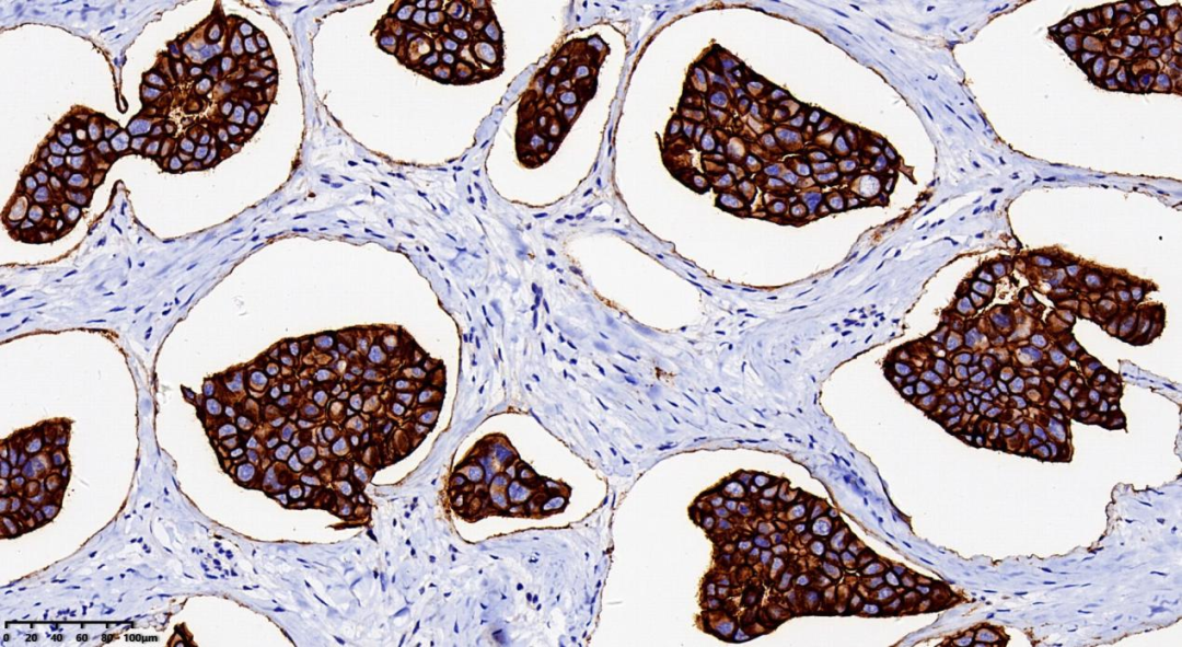 病理干货乳腺浸润性微乳头状癌病例分享