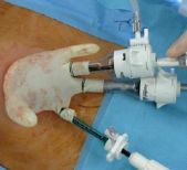 单孔穿刺器厂家有哪些【医说中美】单孔穿刺器_https://www.jmylbn.com_新闻资讯_第9张