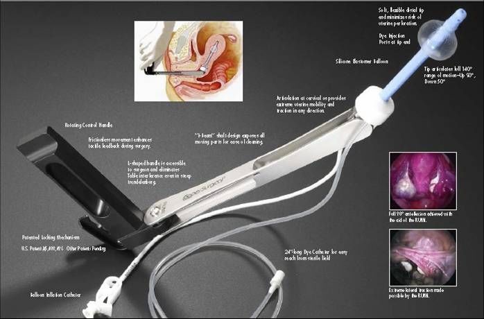 宫腔镜器械怎么安装【医说中美】腔镜器械江湖之举宫器_https://www.jmylbn.com_新闻资讯_第12张