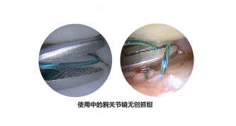 关节钳怎么用更新后的小关节镜微创手术基本器械套件_https://www.jmylbn.com_新闻资讯_第8张