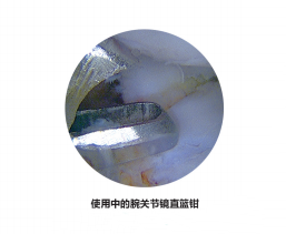 关节钳怎么用更新后的小关节镜微创手术基本器械套件_https://www.jmylbn.com_新闻资讯_第6张