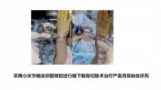 关节钳怎么用更新后的小关节镜微创手术基本器械套件_https://www.jmylbn.com_新闻资讯_第12张