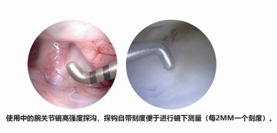 关节钳怎么用更新后的小关节镜微创手术基本器械套件_https://www.jmylbn.com_新闻资讯_第14张