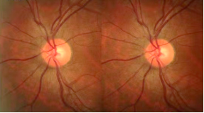 眼底照相有什么用同样是眼底照相，“大芒果”和“大橙子”有什么区别？_https://www.jmylbn.com_新闻资讯_第12张