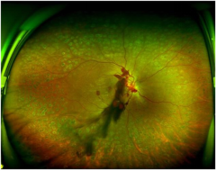 眼底照相有什么用同样是眼底照相，“大芒果”和“大橙子”有什么区别？_https://www.jmylbn.com_新闻资讯_第4张