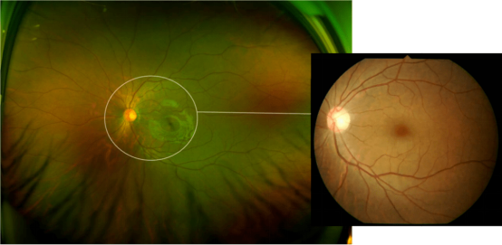眼底照相有什么用同样是眼底照相，“大芒果”和“大橙子”有什么区别？_https://www.jmylbn.com_新闻资讯_第10张