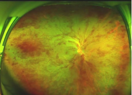 眼底照相有什么用同样是眼底照相，“大芒果”和“大橙子”有什么区别？_https://www.jmylbn.com_新闻资讯_第8张