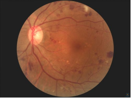 眼底照相有什么用同样是眼底照相，“大芒果”和“大橙子”有什么区别？_https://www.jmylbn.com_新闻资讯_第1张