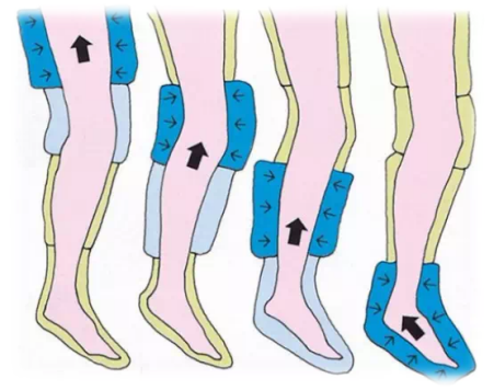 气压治疗仪怎么消毒气压治疗,你了解多少？_https://www.jmylbn.com_新闻资讯_第6张