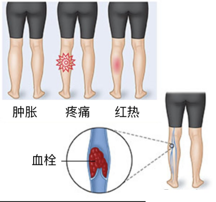 气压治疗仪怎么消毒气压治疗,你了解多少？_https://www.jmylbn.com_新闻资讯_第5张
