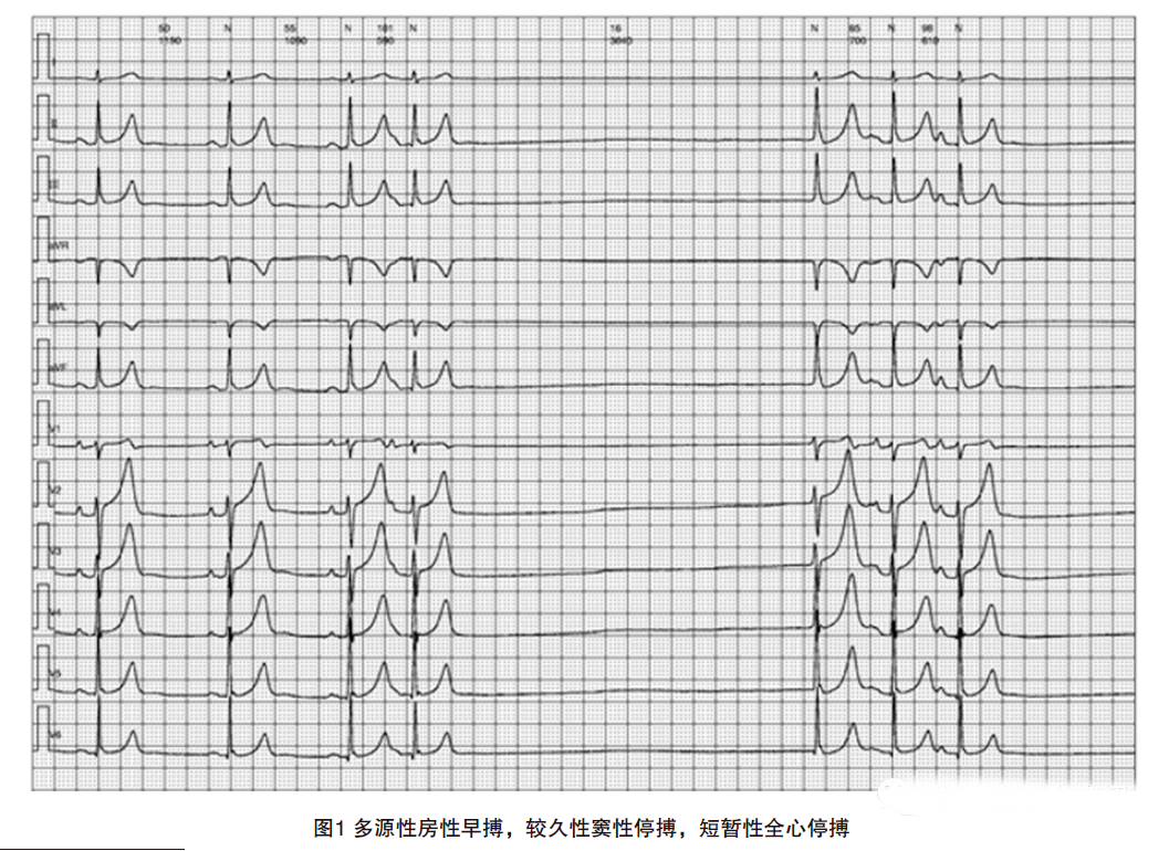 动态心电图怎么分析动态心电图，如何分析和诊断_https://www.jmylbn.com_新闻资讯_第2张