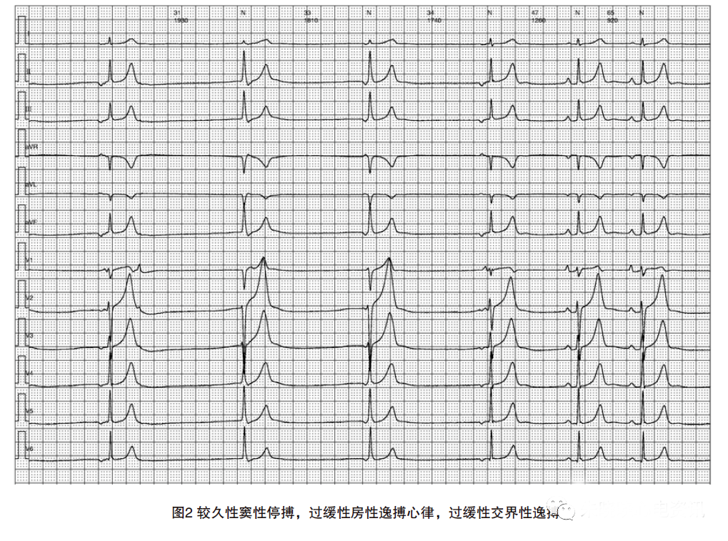 动态心电图怎么分析动态心电图，如何分析和诊断_https://www.jmylbn.com_新闻资讯_第3张