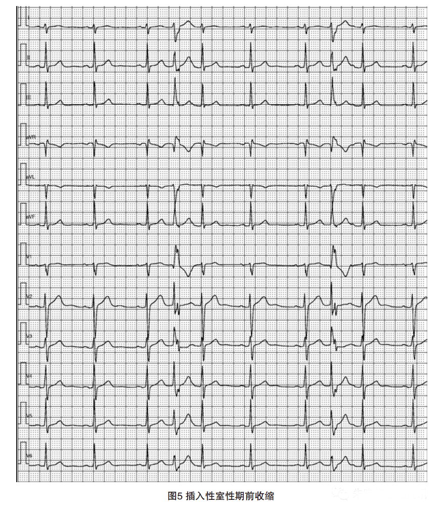动态心电图怎么分析动态心电图，如何分析和诊断_https://www.jmylbn.com_新闻资讯_第7张