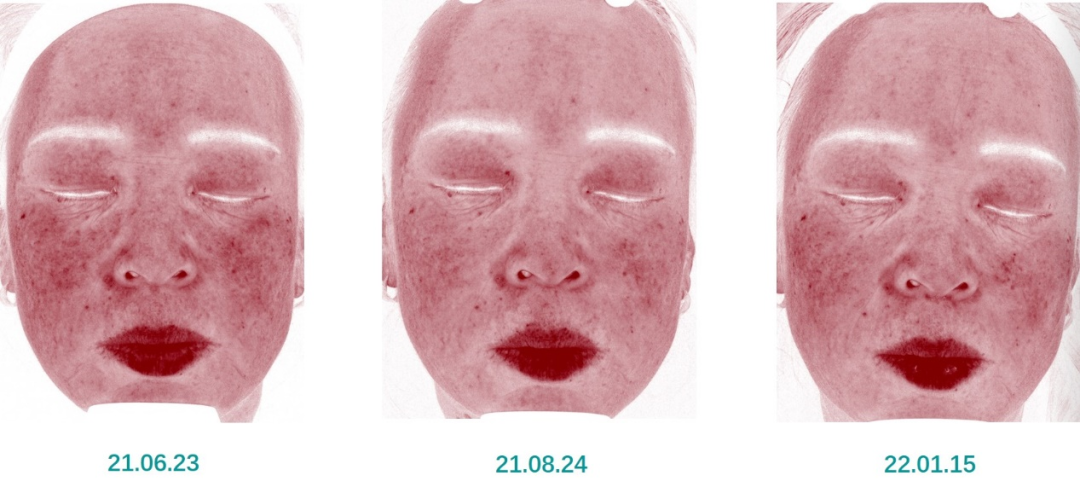 红光治疗怎么用中国研究：薇旖美人源化Ⅲ型胶原蛋白联合红光治疗在皮肤美容中的应用效果_https://www.jmylbn.com_新闻资讯_第11张