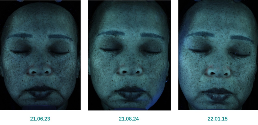 红光治疗怎么用中国研究：薇旖美人源化Ⅲ型胶原蛋白联合红光治疗在皮肤美容中的应用效果_https://www.jmylbn.com_新闻资讯_第13张