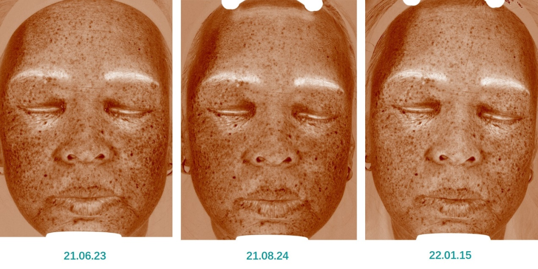 红光治疗怎么用中国研究：薇旖美人源化Ⅲ型胶原蛋白联合红光治疗在皮肤美容中的应用效果_https://www.jmylbn.com_新闻资讯_第12张