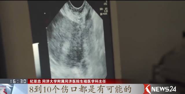 取卵针长什么样取卵的真相_https://www.jmylbn.com_新闻资讯_第12张