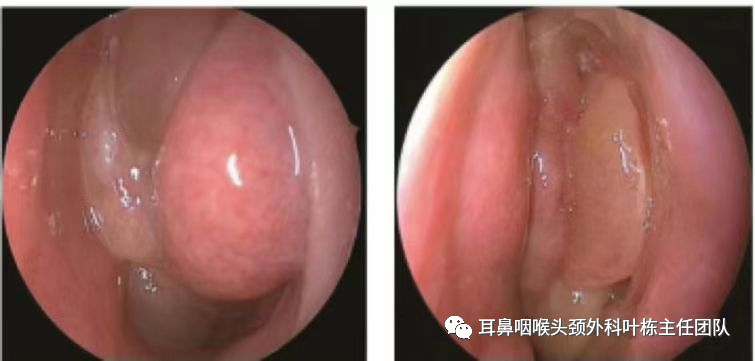 操作鼻窦镜时怎么摆术后指南：鼻内镜下鼻窦炎术后注意事项及护理要点_https://www.jmylbn.com_新闻资讯_第2张